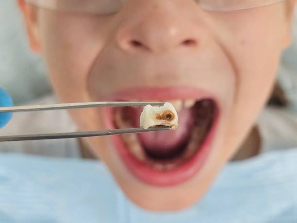 Best Knocked-Out Tooth (Avulsed Tooth) Treatment in Hiram, OH